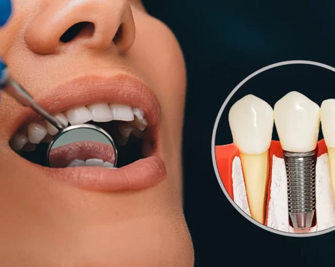 dental implants 