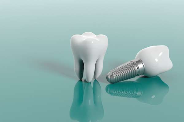 dental implants 